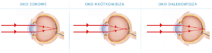 Дефект глаза - это неспособность глаза создать правильное сфокусированное изображение на центральной сетчатке, что приводит к снижению остроты зрения